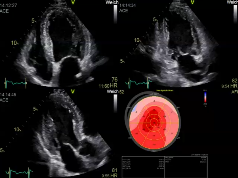 common-mistakes-left-ventricular-hypertrophy-123-sonography